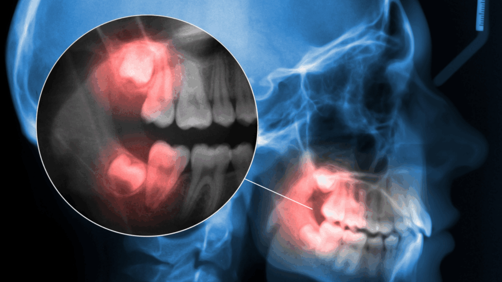 Wisdom Tooth Extractions: It’s Not as Bad as You Might Think